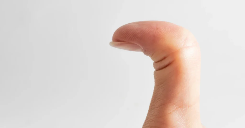Thumb held up to estimate size without a ruler